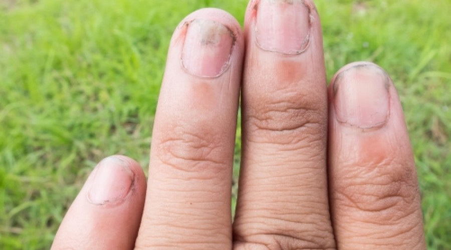 Онихомикоза (гъбички по ноктите) – същност, причини, симптоми, диагностика и лечение