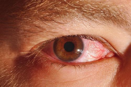 Причини и симптоми на конюнктивит - инфекция на очите.