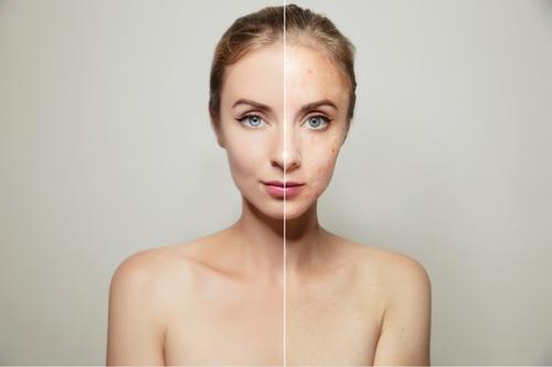 Симптом или болест на кожата е акнето по лицето?